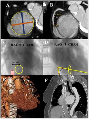 Transcatheter tricuspid valve interventions: Current status and future perspectives
